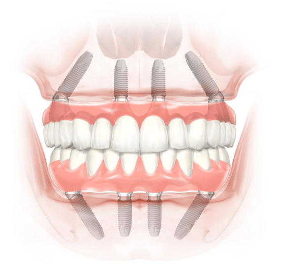 l’All-on-4 repose sur la pose de quatre implants dentaires